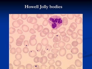 Howell Jolly bodies
 