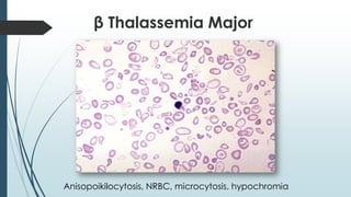 β Thalassemia Major
Anisopoikilocytosis, NRBC, microcytosis, hypochromia
 