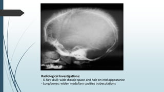 Radiological Investigations:
- X-Ray skull: wide diploic space and hair on end appearance
- Long bones: widen medullary cavities trabeculations
 
