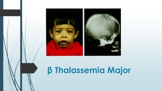 β Thalassemia Major
 