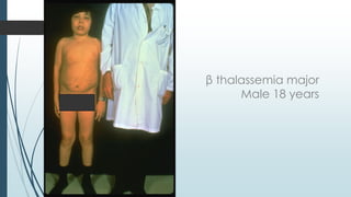 β thalassemia major
Male 18 years
 