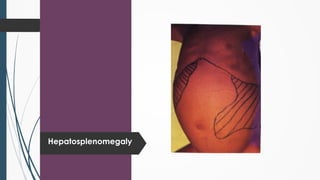 Hepatosplenomegaly
 