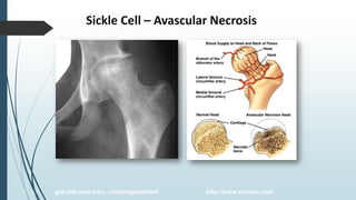 Sickle Cell – Avascular Necrosis
gait.aidi.udel.edu/.../clcsimge/sickle5 http://www.zimmer.com
 