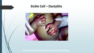 Sickle Cell – Dactylitis
http://aapredbook.aappublications.org/week/116_09.jpg
 