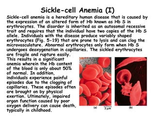 Sickle-cell Anemia (I)
Sickle-cell anemia is a hereditary human disease that is caused by
the expression of an altered form of Hb known as Hb S in
erythrocytes. The disorder is inherited as an autosomal recessive
trait and requires that the individual have two copies of the Hb S
allele. Individuals with the disease produce variably shaped
erythrocytes (Fig. 5-19) that are prone to lysis and can clog the
microvasculature. Abnormal erythrocytes only form when Hb S
undergoes deoxygenation in capillaries. The sickled erythrocytes
are fragile and rupture easily.
This results in a significant
anemia wherein the Hb content
of the blood is only about 50%
of normal. In addition,
individuals experience painful
episodes due to the clogging of
capillaries. These episodes often
are brought on by physical
exertion. Ultimately, impaired
organ function caused by poor
oxygen delivery can cause death,
typically in childhood.
 