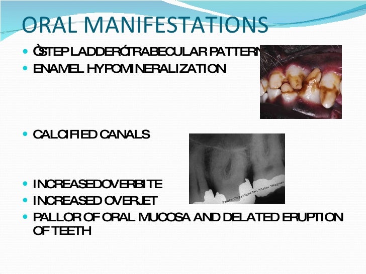 Haemolytic Anaemias in dentistry
