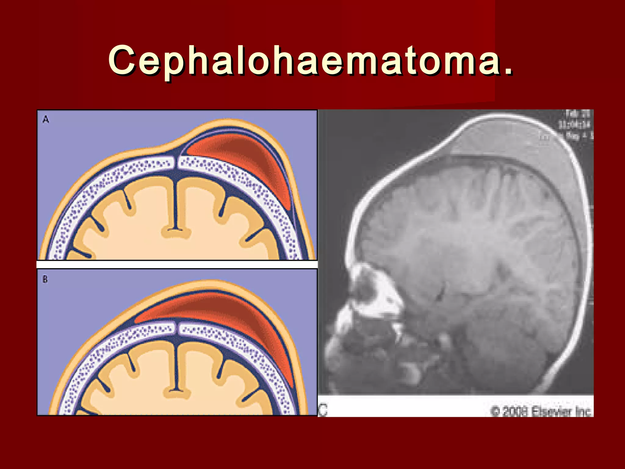 Haemophilia PPT haemophilia-ppt