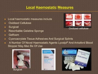 Local Haemostatic Measures
 Local haemostatic measures include
 Oxidised Cellulose
 Surgicel
 Resorbable Gelatine Sponge
 Gelfoam
 Cyanoacrylate Tissue Adhesives And Surgical Splints
 A Number Of Novel Haemostatic Agents Lyostpt® And Ankaferd Blood
Stopper May Also Be Of Use
Oxidized cellulose
Surgicel
 