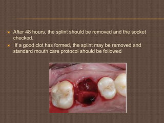  After 48 hours, the splint should be removed and the socket
checked.
 If a good clot has formed, the splint may be removed and
standard mouth care protocol should be followed
 