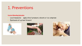 1. Preventions
Control Bleeding Episodes
• Local measures: apply direct pressure; elevate or ice compress
• Epistaxsis sit up lean forward
 
