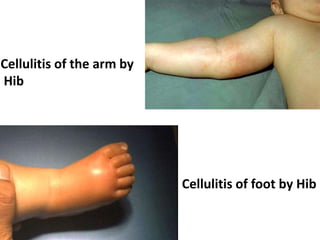 Cellulitis of the arm by
Hib
Cellulitis of foot by Hib
 
