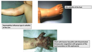 Haemophilus Influenza type b cellulitis
of the arm
Hib cellulitis of the foot
Infant with Severe Vasculitis with Disseminated
Intravascular coagulation with gangrene of the
hand secondary to Hib septicaemia
 