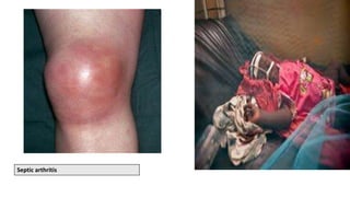Septic arthritis
 