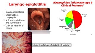 Inferior view of a brain infected with Hib bacteria
 