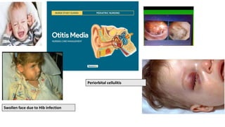 Periorbital cellulitis
Swollen face due to Hib infection
 
