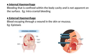 • Internal Haemorrhage
Bleeding that is confined within the body cavity and is not apparent on
the surface. Eg: Intra cranial bleeding
• External Haemorrhage
Blood escaping through a wound in the skin or mucosa.
Eg: Epistaxis
 