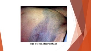 Fig: Internal Haemorrhage
 