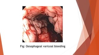 Fig: Oesophageal variceal bleeding
 