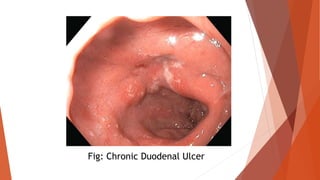 Fig: Chronic Duodenal Ulcer
 