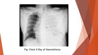 Fig: Chest X-Ray of Haemothorax
 