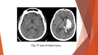 Fig: CT scan of head injury
 