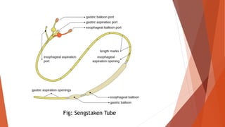 Fig: Sengstaken Tube
 