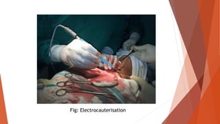 Fig: Electrocauterisation
 