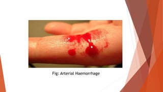 Fig: Arterial Haemorrhage
 