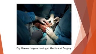 Fig: Haemorrhage occurring at the time of Surgery
 