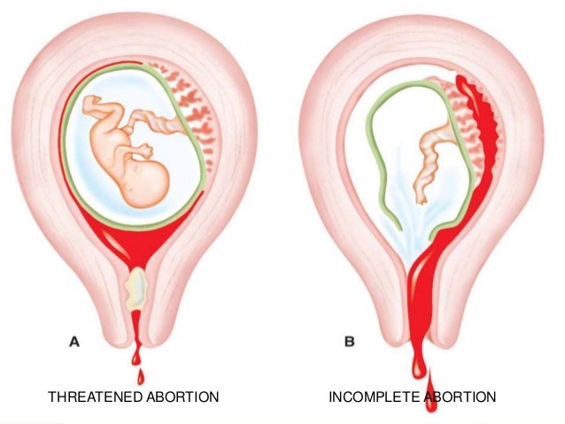 Can You Hemorrhage From A Miscarriage