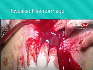 Revealed Haemorrhage

 