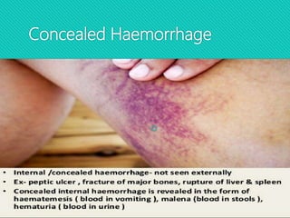 Concealed Haemorrhage

 