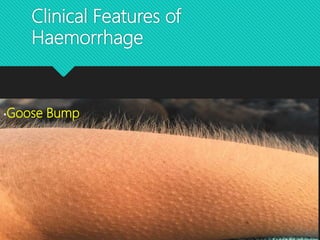 Clinical Features of
Haemorrhage
•Goose Bump
 