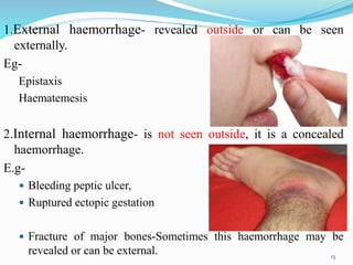 1.External haemorrhage- revealed outside or can be seen
externally.
Eg-
Epistaxis
Haematemesis
2.Internal haemorrhage- is not seen outside, it is a concealed
haemorrhage.
E.g-
 Bleeding peptic ulcer,
 Ruptured ectopic gestation
 Fracture of major bones-Sometimes this haemorrhage may be
revealed or can be external. 13
 