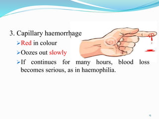 3. Capillary haemorrhage
Red in colour
Oozes out slowly
If continues for many hours, blood loss
becomes serious, as in haemophilia.
15
 