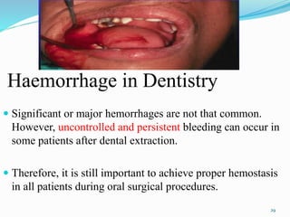Haemorrhage in Dentistry
 Significant or major hemorrhages are not that common.
However, uncontrolled and persistent bleeding can occur in
some patients after dental extraction.
 Therefore, it is still important to achieve proper hemostasis
in all patients during oral surgical procedures.
29
 