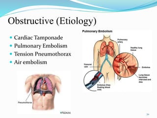Obstructive (Etiology)
 Cardiac Tamponade
 Pulmonary Embolism
 Tension Pneumothorax
 Air embolism
70
 