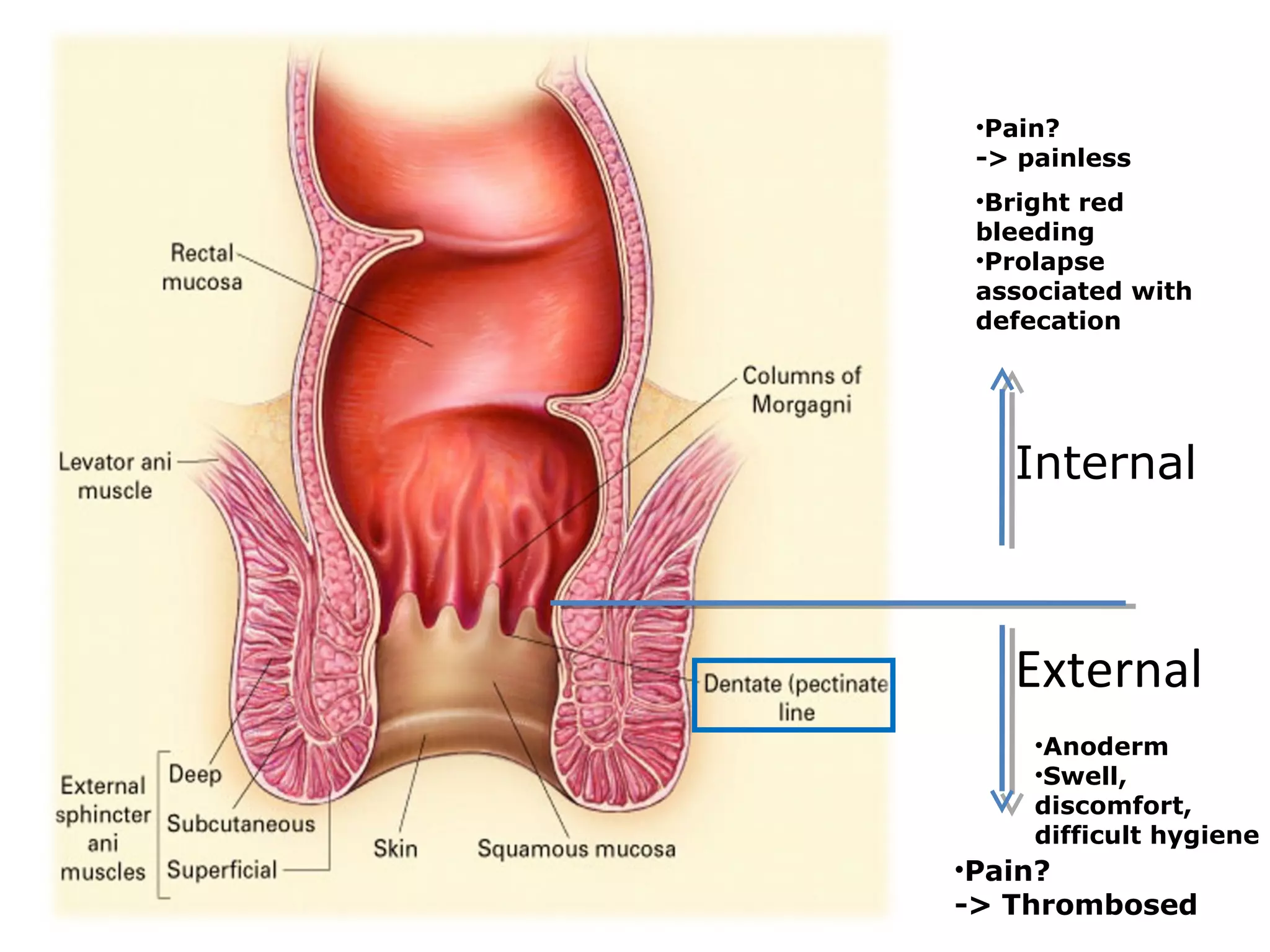 External
Internal
•Anoderm
•Swell,
discomfort,
difficult hygiene
•Pain?
-> Thrombosed
•Pain?
-> painless
•Bright red
bleeding
•Prolapse
associated with
defecation
 