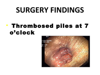 SURGERY FINDINGS
 Thrombosed piles at 7
o’clock
 