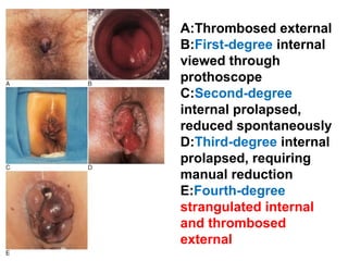 A:Thrombosed external
B:First-degree internal
viewed through
prothoscope
C:Second-degree
internal prolapsed,
reduced spontaneously
D:Third-degree internal
prolapsed, requiring
manual reduction
E:Fourth-degree
strangulated internal
and thrombosed
external
 