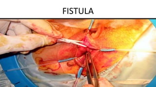 FISTULA
 