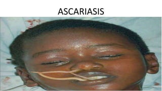 ASCARIASIS
 