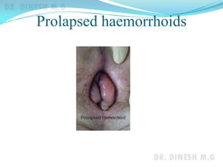 Prolapsed haemorrhoids
 