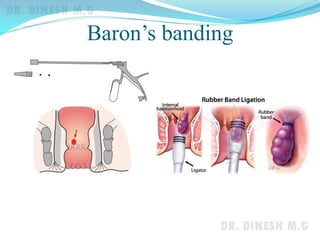 Baron’s banding
 