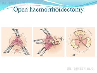 Open haemorrhoidectomy
 