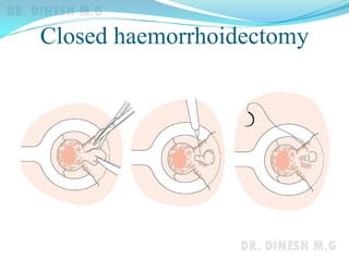 Closed haemorrhoidectomy
 
