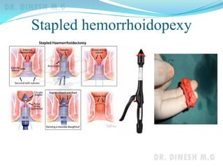Stapled hemorrhoidopexy
 
