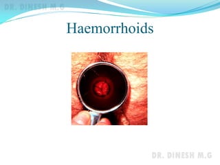Haemorrhoids
 