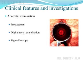 Clinical features and investigations
 Anorectal examination
 Proctoscopy
 Digital rectal examination
 Sigmoidoscopy
 