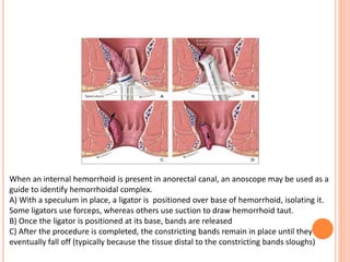 When an internal hemorrhoid is present in anorectal canal, an anoscope may be used as a
guide to identify hemorrhoidal complex.
A) With a speculum in place, a ligator is positioned over base of hemorrhoid, isolating it.
Some ligators use forceps, whereas others use suction to draw hemorrhoid taut.
B) Once the ligator is positioned at its base, bands are released
C) After the procedure is completed, the constricting bands remain in place until they
eventually fall off (typically because the tissue distal to the constricting bands sloughs)
 